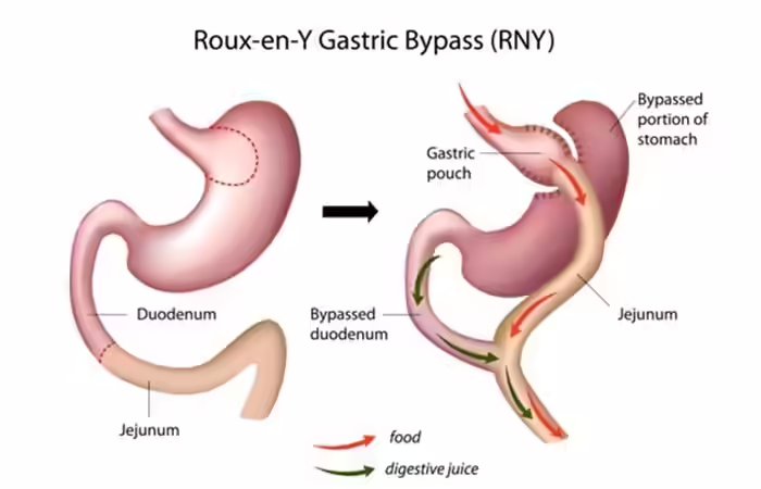 Roux-en-Y Gastric Bypass Weight Loss Surgery - Roux-en-Y Gastric Bypass