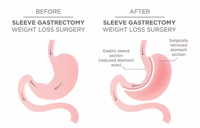 Gastric Sleeve Surgery Weight Loss Surgery - Gastric Sleeve Surgery