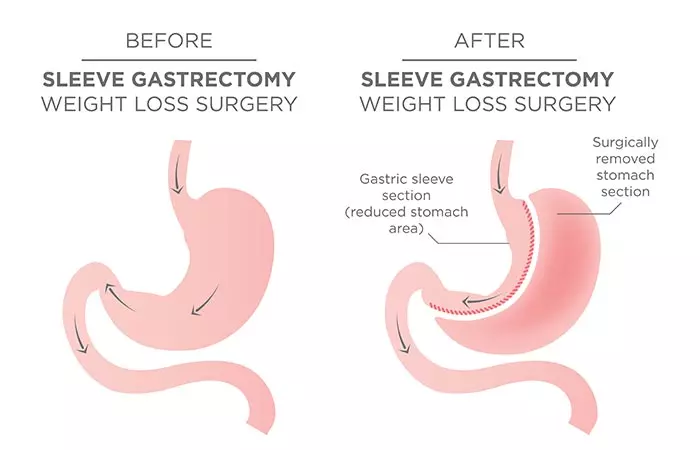 Weight Loss Surgery - Gastric Sleeve Surgery