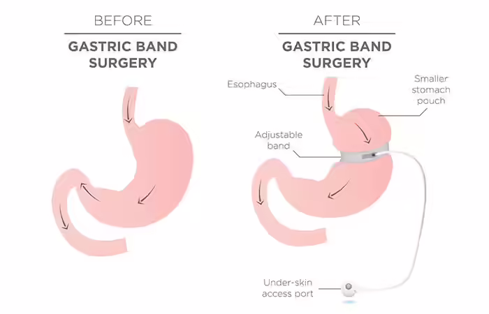 Adjustable Gastric Band Surgery Weight Loss Surgery - Adjustable Gastric Band Surgery