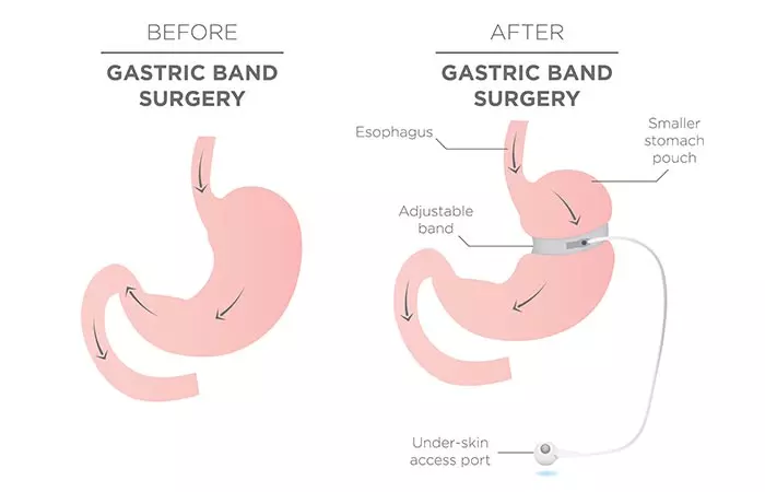 Weight Loss Surgery - Adjustable Gastric Band Surgery