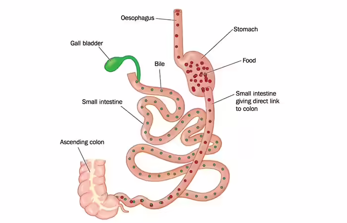 Duodenal Switch Surgery Weight Loss Surgery - Duodenal Switch Surgery