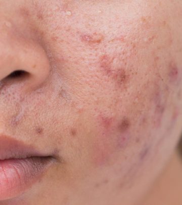 8 Myths About Acne That Are Making It Difficult For You To Get Rid Of It