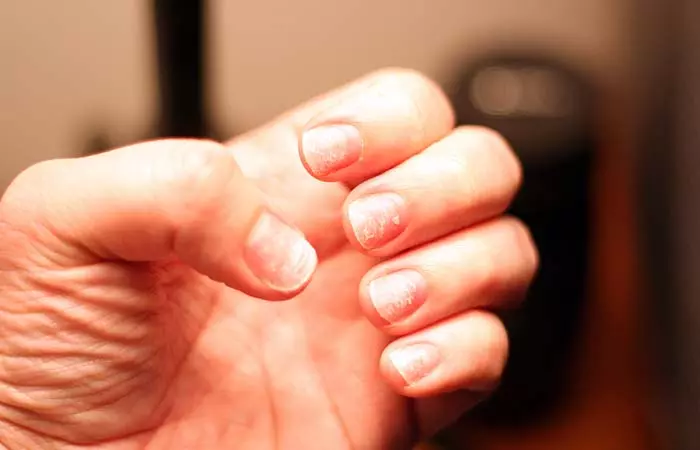 9. Weak Nails