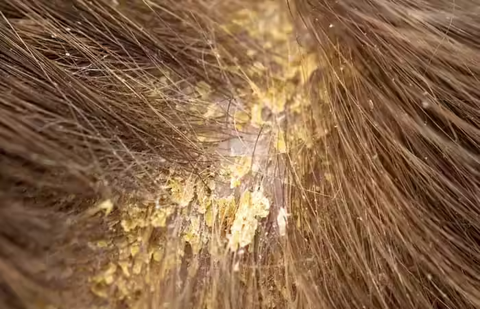 Eczema