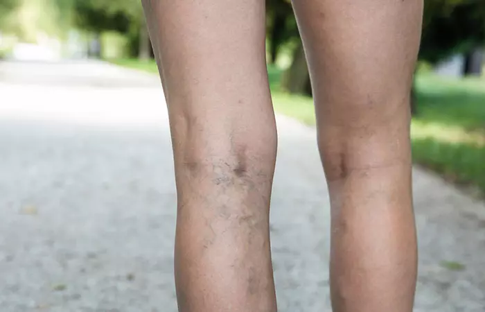 3. Varicose Veins