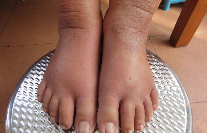 1. Swollen Ankles And Legs