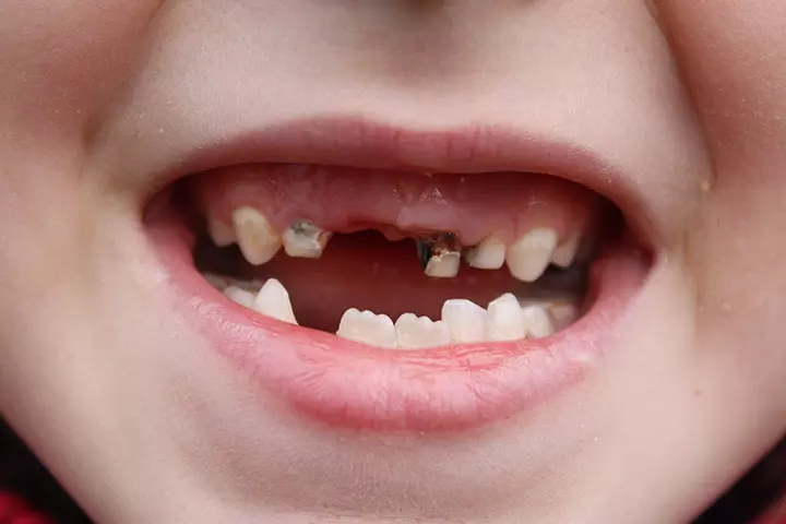 Are Bottles Bad For Babies' Teeth A Pediatric Dentist Explains1