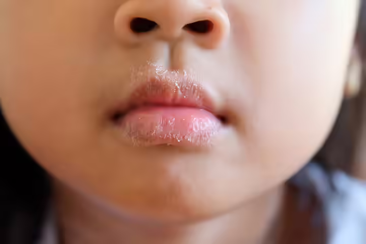 Dry, Parched Mouth