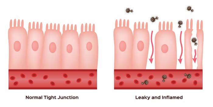 Heal Leaky Gut