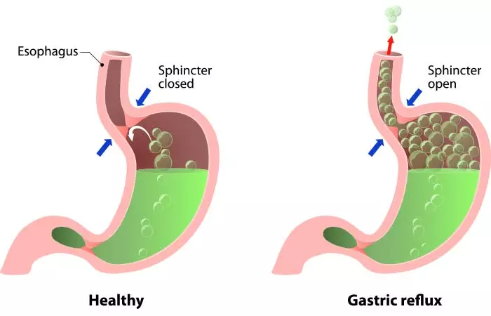 Manage GERD And Heartburn