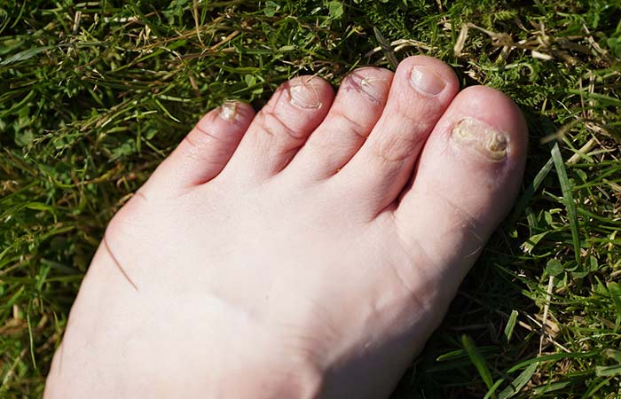 What Causes Skin Fungus 