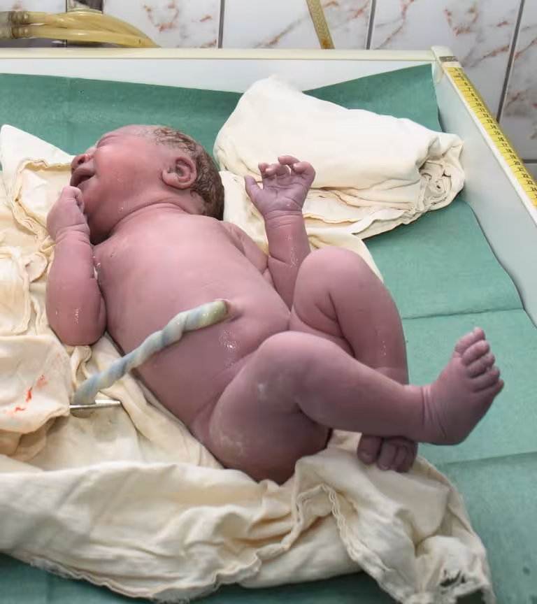 What Is Delayed Cord Clamping And How Is It Beneficial