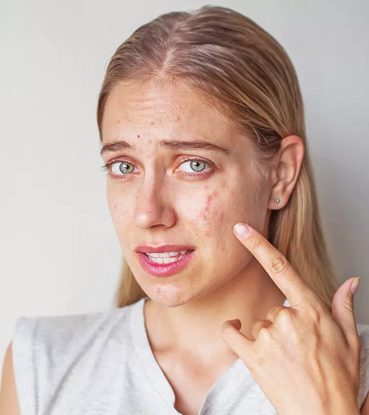 Does Stress Cause Acne? What Is The Link Between Them?_image