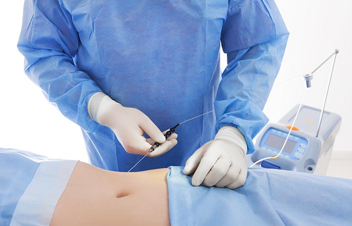 How Does Laser Liposuction Work