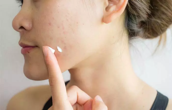 How To Control Your Breakouts