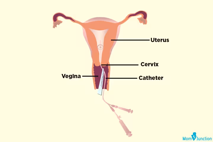 Hysterosalpingography When And Why Is It Done Hysterosalpingography When And Why Is It Done