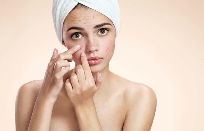 Is There Any Link Between Dairy And Acne
