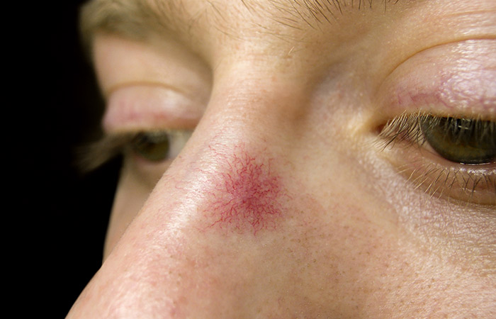 Visible Eyelid And Nostril Capillaries Visible Eyelid And Nostril Capillaries