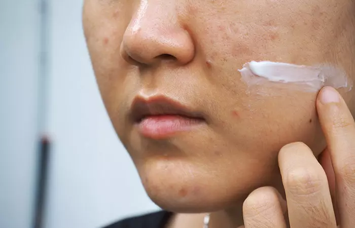 How Does Accutane Treat Acne