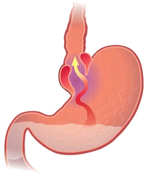 What Causes GERD