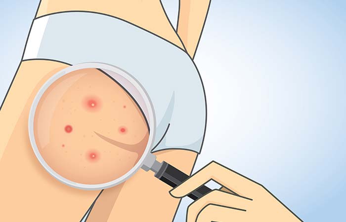 What Causes Pimples On The Buttocks And Thighs