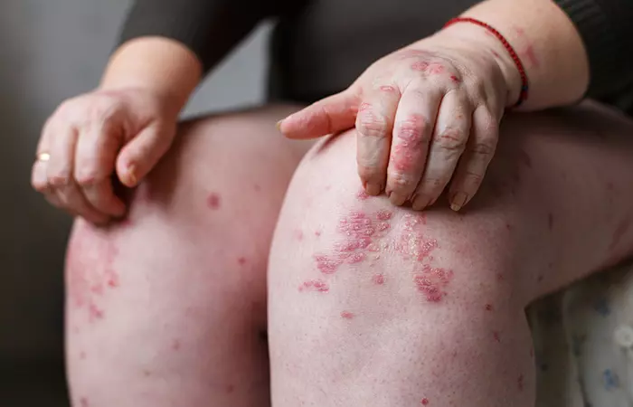 Causes Of Psoriasis