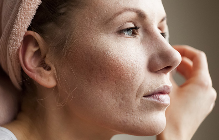 How Do Probiotics Help With Acne Is There A Link