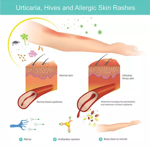 How Does Histamine Trigger An Allergic Reaction