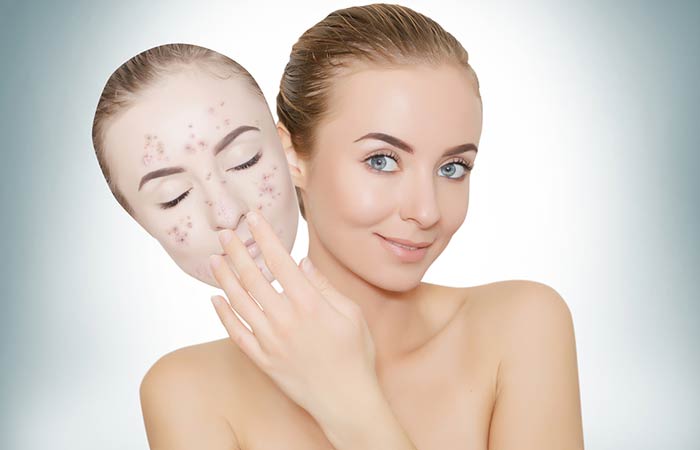 What Is Acne