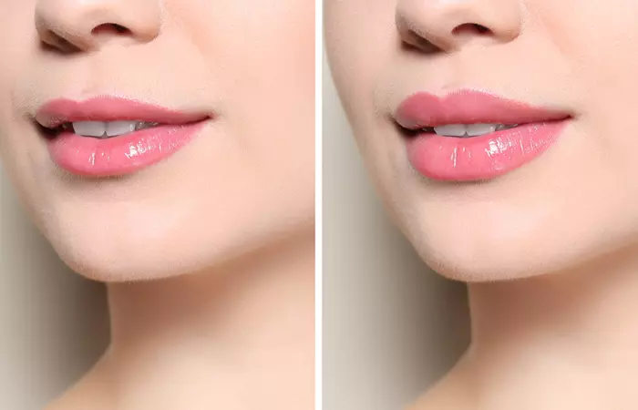 Types-Of-Lip-Fillers