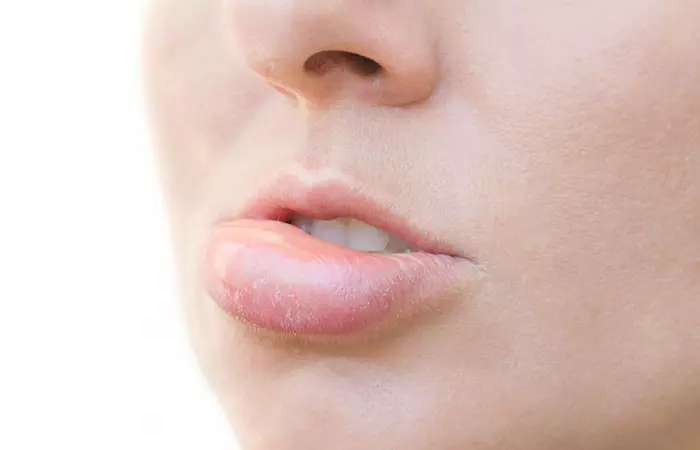 What-Are-The-Side-Effects-And-Risks-Involved-In-Lip-Augmentation