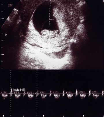 10th Week Ultrasound Baby Development, Abnormalities And More