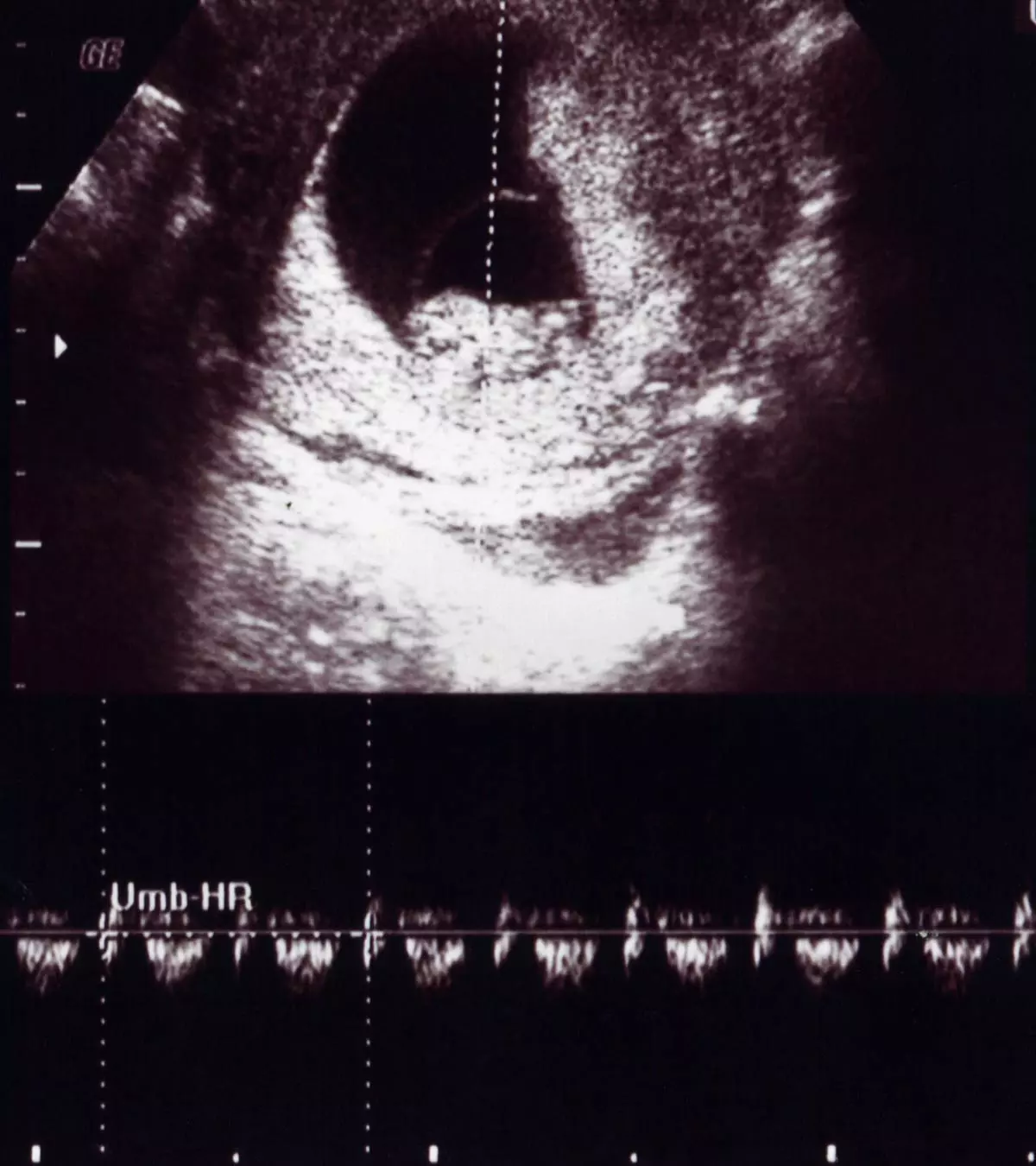 10th Week Ultrasound: Baby Development, Abnormalities And More_image