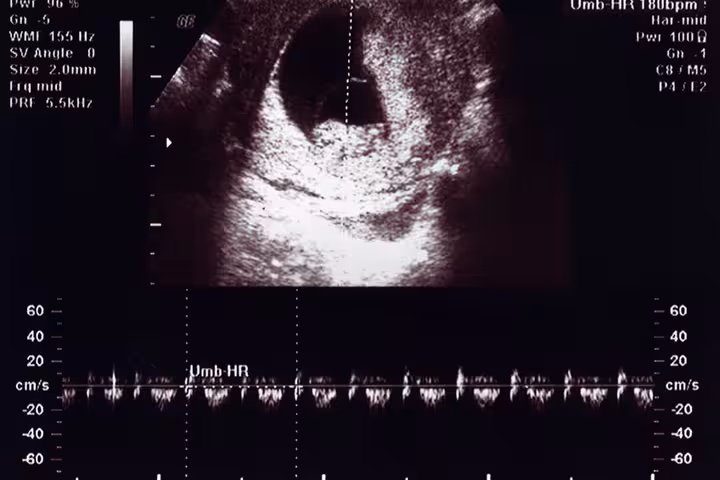 10th Week Ultrasound Baby Development, Abnormalities And More