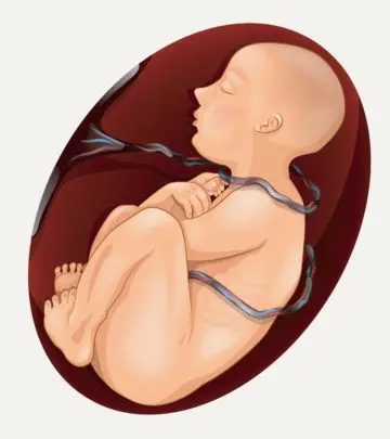 Most cases are not severe, and the cord usually unwinds during birth.