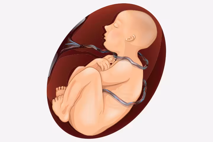 Nuchal cord Causes