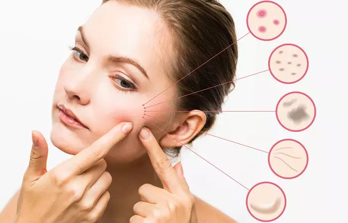 Tips for preventing acne