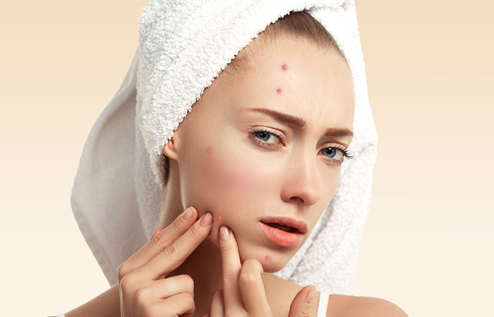 Treats Acne