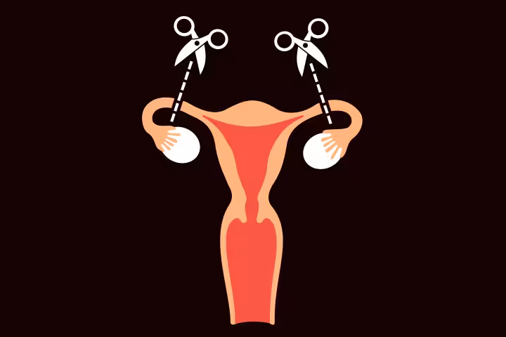Tubal Ligation Reversal Process, Risks, Cost And Alternatives
