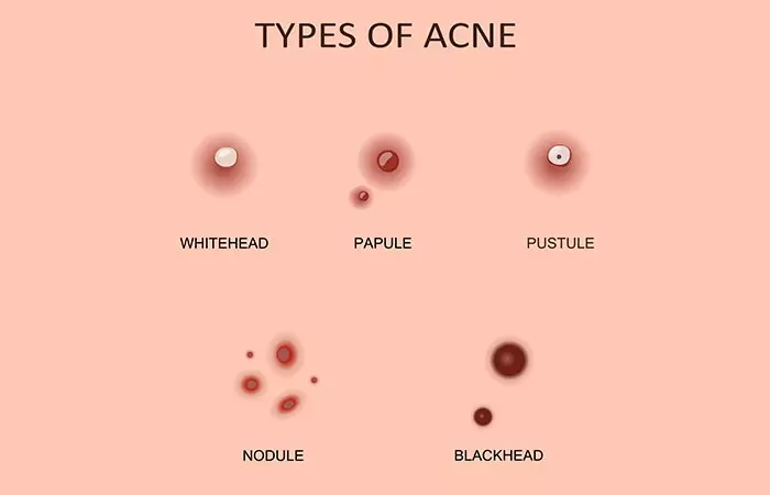 Types of Pimples