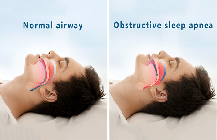 What Is Sleep Apnea - Anti-Snoring Pillows