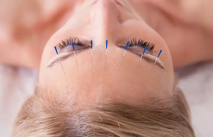 5. Get Instant Relief With Acupuncture