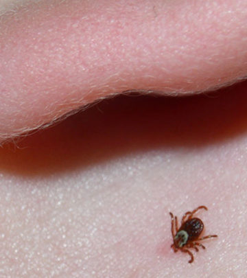 A Boy Heard a Buzzing Sound in His Ear. It Was a Tick on His Eardrum