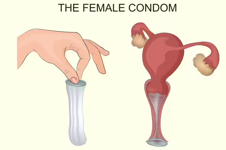 Female condom as non-hormonal birth control method Female condom as non-hormonal birth control method