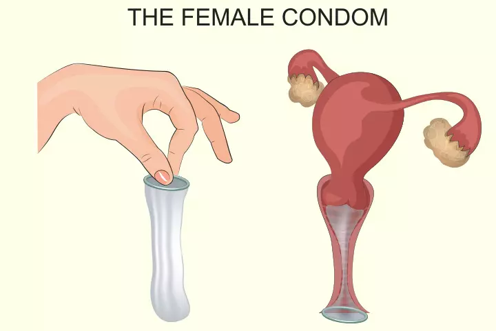 Female condom as non-hormonal birth control method