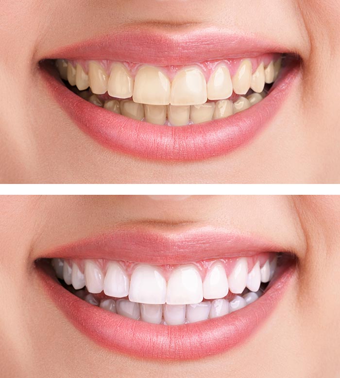 How To Get Whiter Teeth Quickly