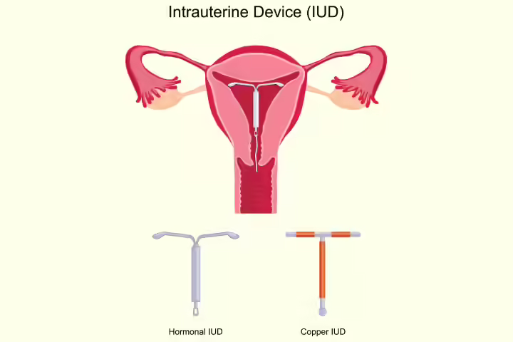 Intrauterine device as non-hormonal birth control method Intrauterine device as non-hormonal birth control method