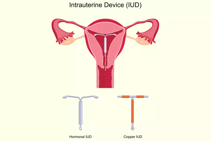 Intrauterine device as non-hormonal birth control method