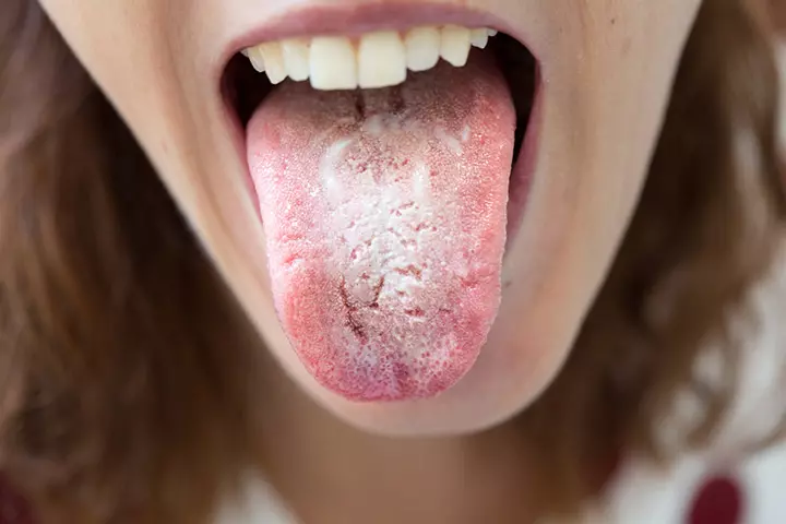 Signs And Symptoms Of Oral Thrush